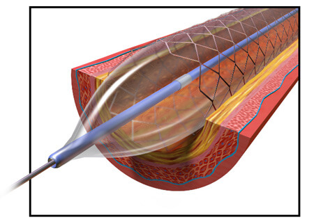 Illustration of Inflated Angioplasty Balloon in Blood Vessel