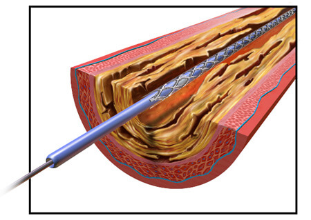 Illustration of Deflated Angioplasty Balloon in Blood Vessel
