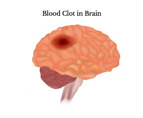 Blood Clot in Brain