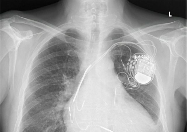 X-Ray Showing Medical Defibrillator in Chest Cavity