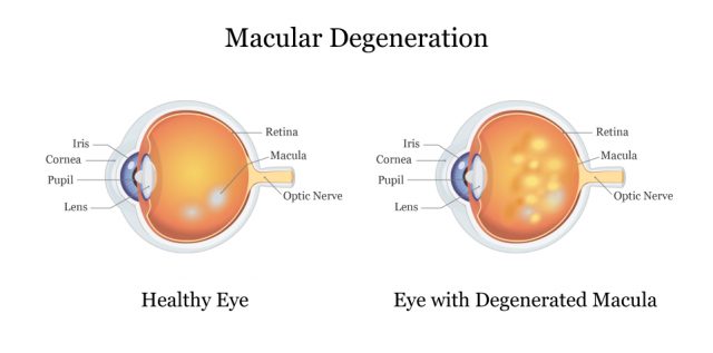 Healthy Eye vs. Eye with Degenerated Macula