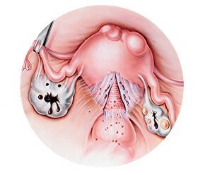 How Endometriosis Impacts the Uterus