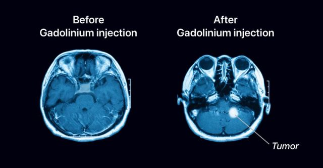 The effect of Gadolinium exposed to MRI scanning.