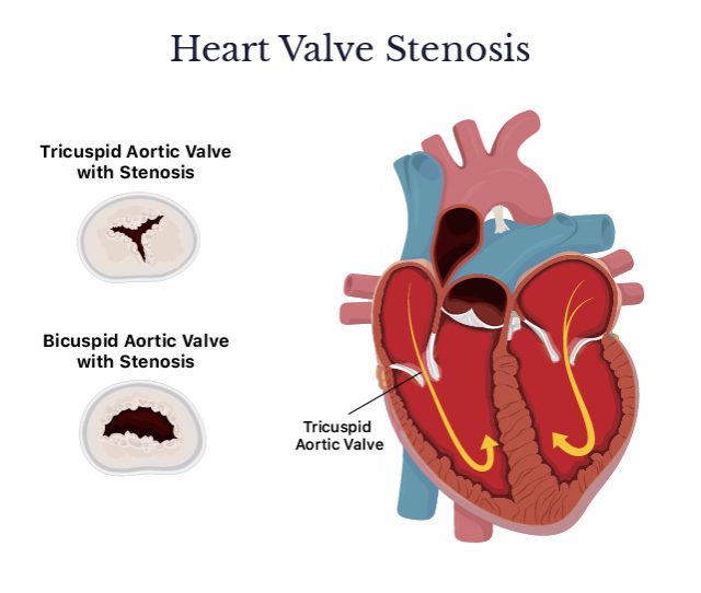 Heart valve stenosis