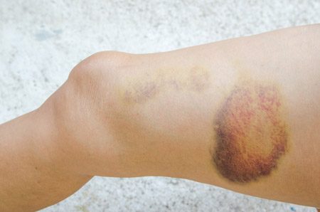 Image of a hematoma on a leg