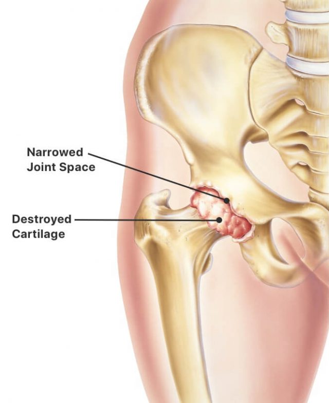 Cartilage damage in hip bone