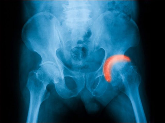 xray demonstrating hip pain