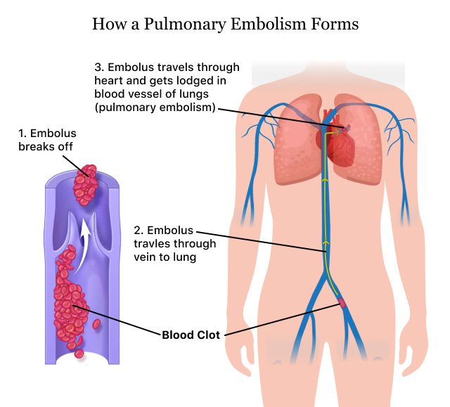 How a Pulmonary Embolism forms