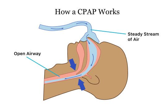 Image displaying how a CPAP works to treat sleep apnea