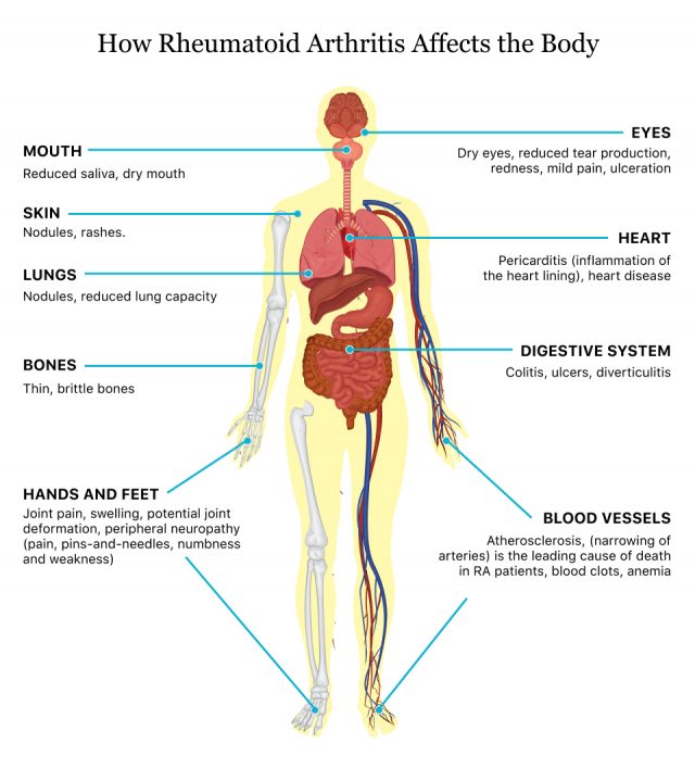 How Rheumatoid Arthritis Affects the Body