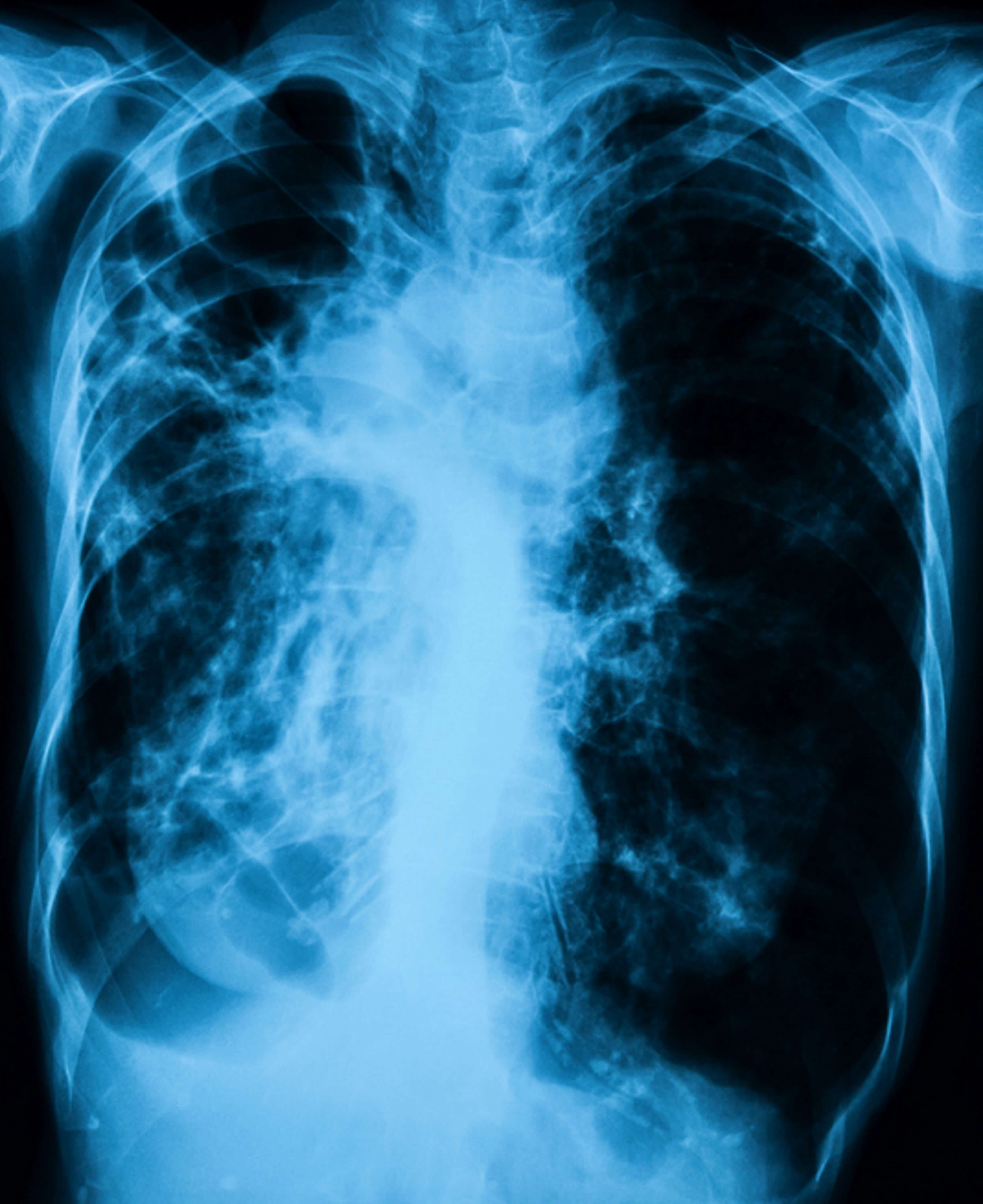 Chest x-ray image showing infection of lungs