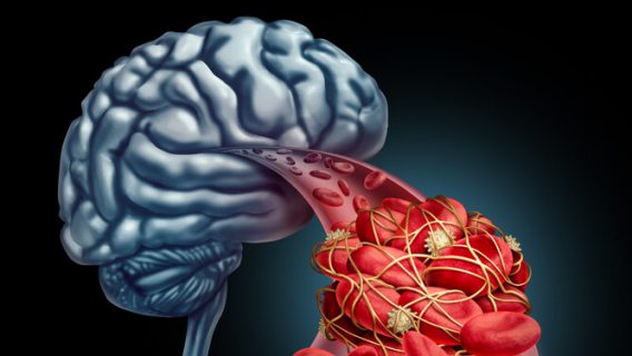 Blood clot and the brain
