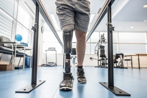 Man standing with amputated leg