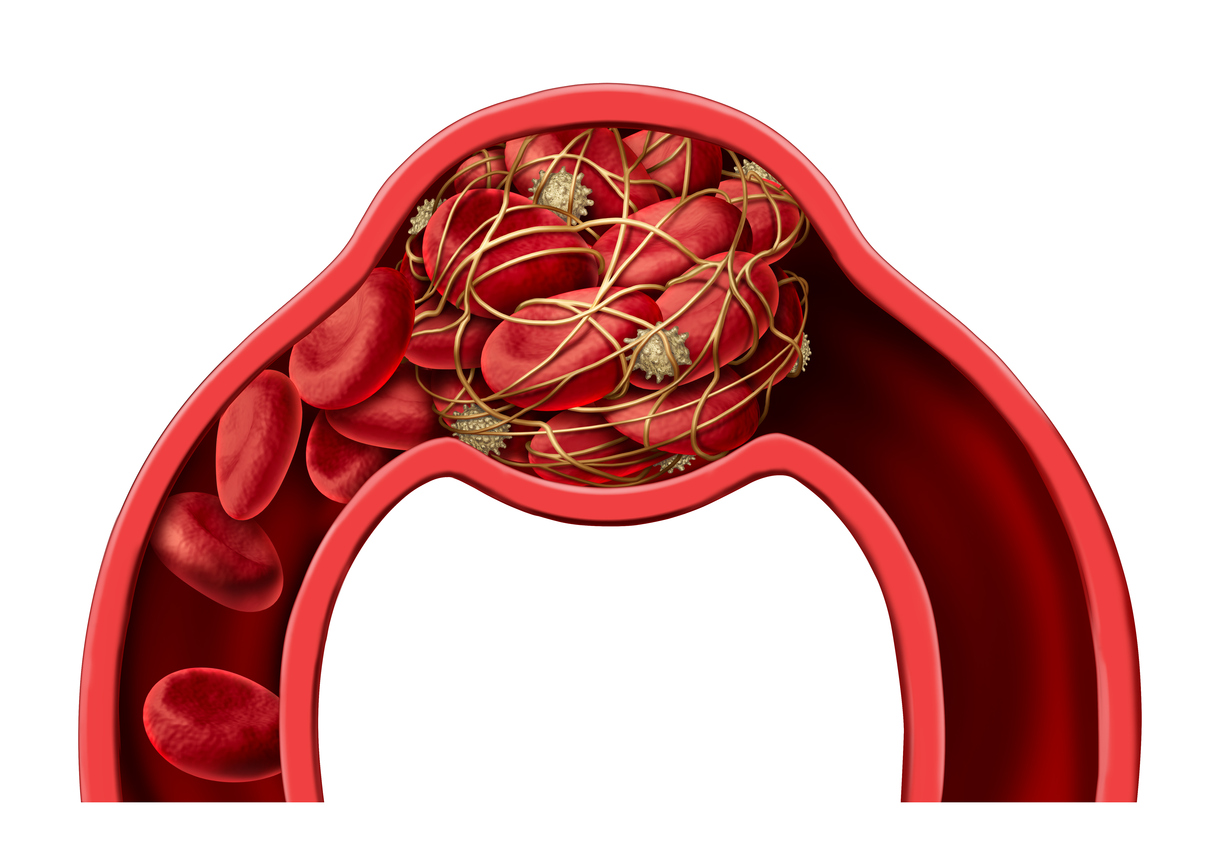 3D illustration of blood clot disease
