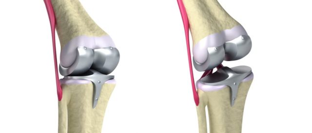 knee replacement recall