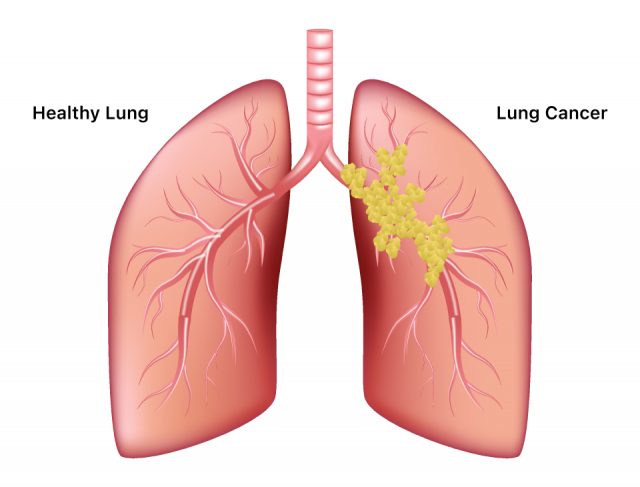 Healthy lung vs. cancer lung