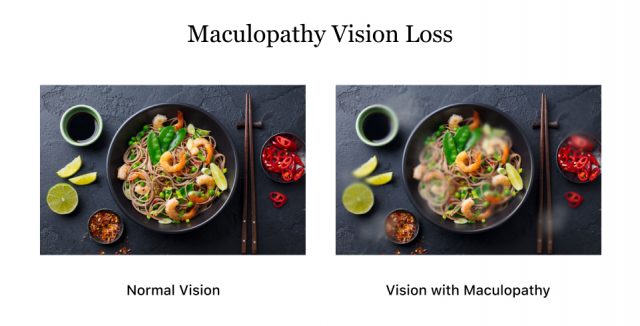 Vision loss from maculopathy