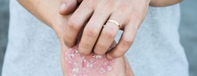 Man with psoriasis on his hand