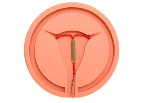 Mirena is an intrauterine device, or IUD.