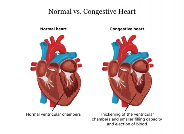 Normal vs. Congestive Heart
