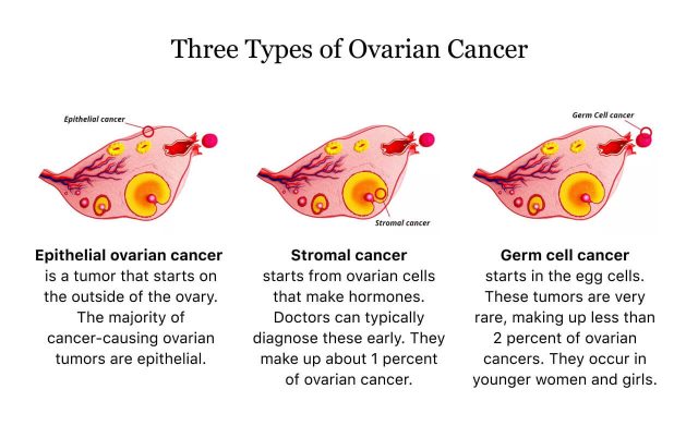 Types of Ovarian Cancer