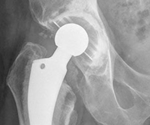 x-ray of partial hip replacement