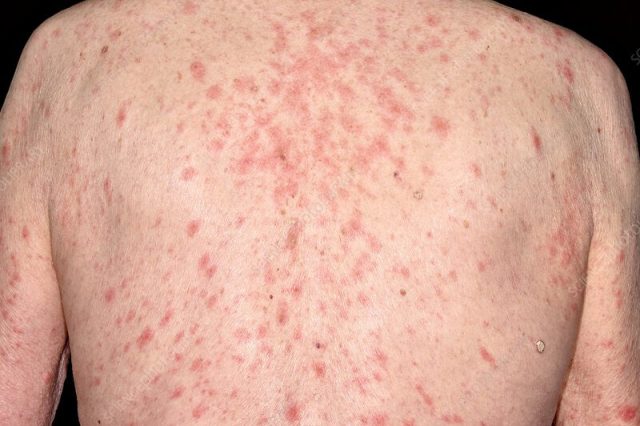 Skin rash on a person's back