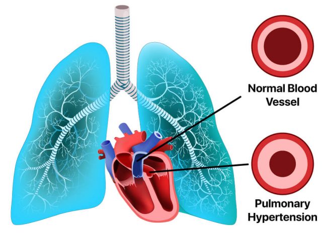 pulmonary hypertension illustration
