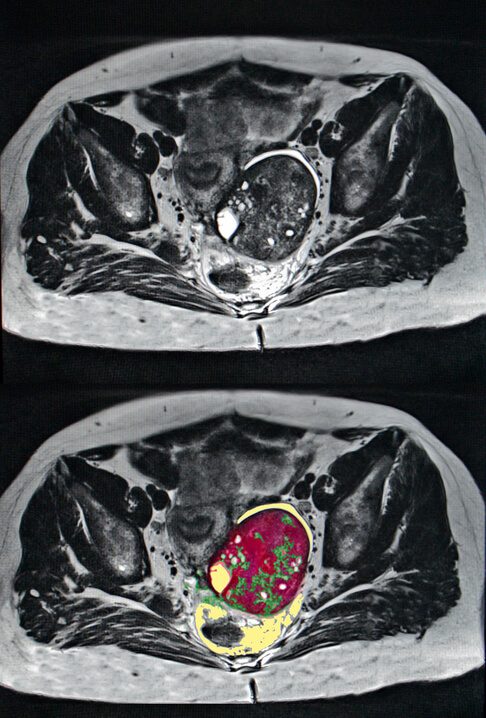 Ovarian cancer scan