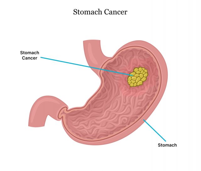 Diagram of stomach tumor