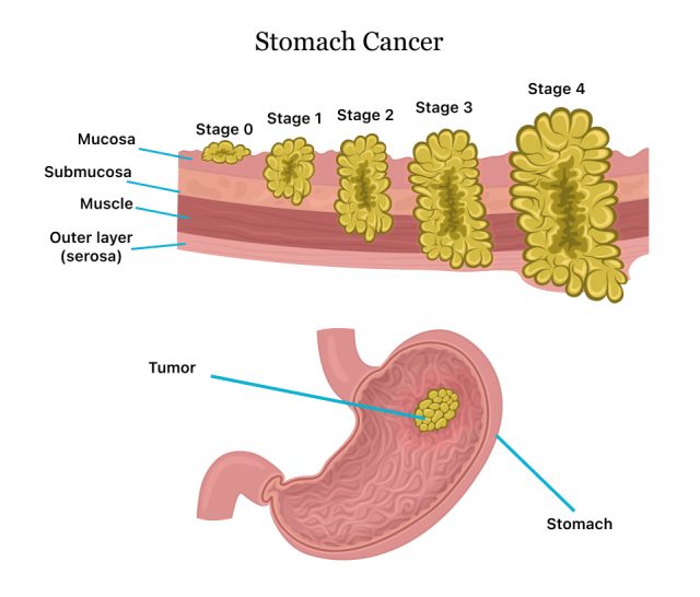 Diagram showing the stages of stomach cancer