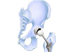 Stryker hip replacement