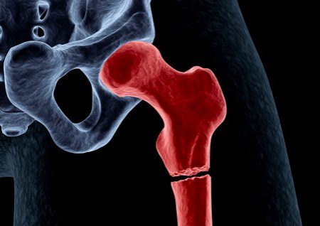 Bone Fracture X-Ray