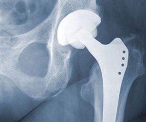 Total Hip Replacement