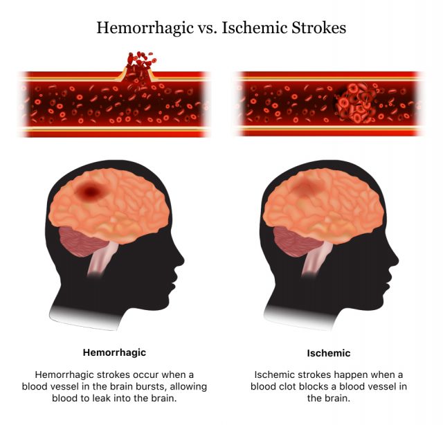 Hemorraghic vs. Ischemic Strokes