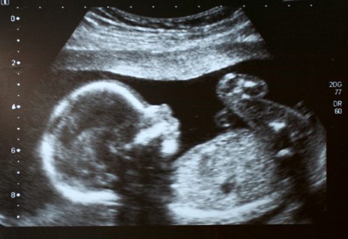 Ultrasound of fetus