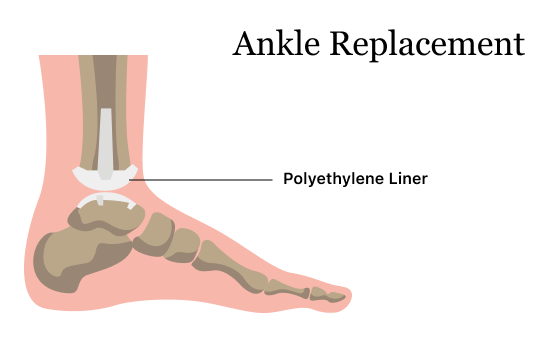 Diagram of an ankle replacement