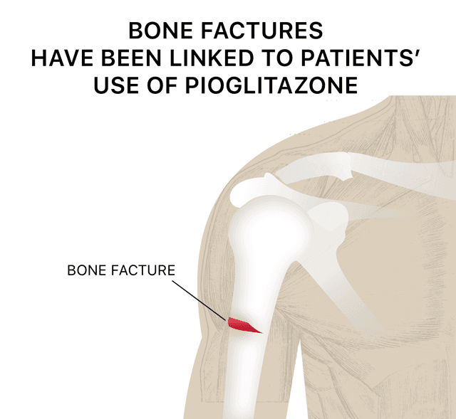 Image that illustrates how bone fractures have been linked to patients’ use of pioglitazone.