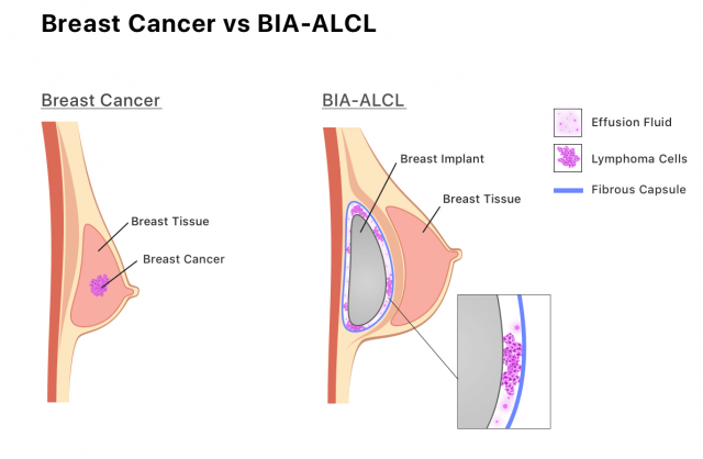 Infographic showing how BIA-ALCL develops in the fluid or scar tissue
