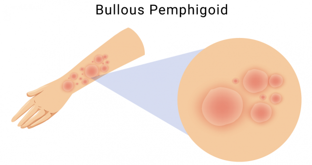 Illustration of bullous pemphigoid