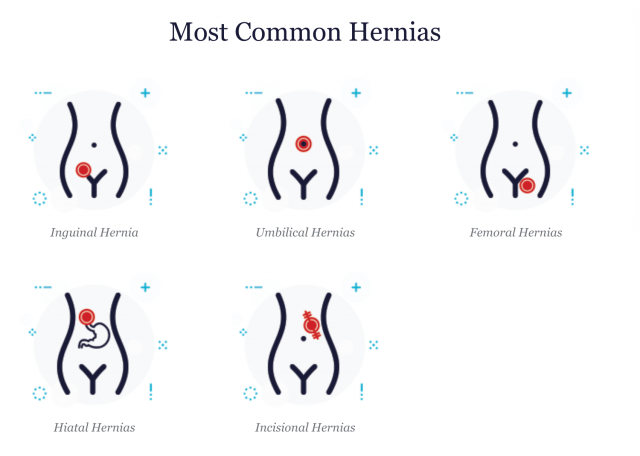 Most Common Hernia