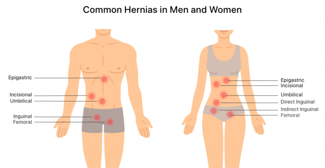 Common hernia locations in men and women