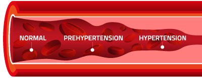 Hypertension Diagram