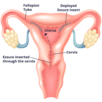 Diagram of How Essure is Inserted