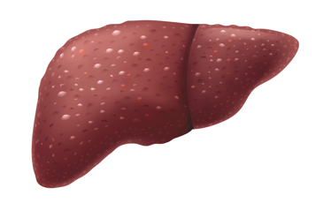 Illustration of liver failure.