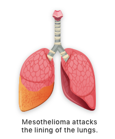 Illustration of mesothelioma in lungs.