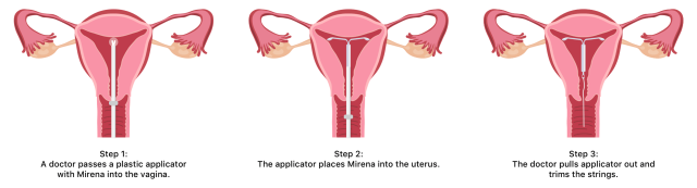 Mirena Insertion Procedure Illustration