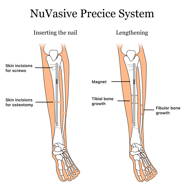 Graphic showing how NuVasive's Precice system treats limb length discrepancies