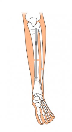 Image showing how a rod is placed to treat limb length discrepancy