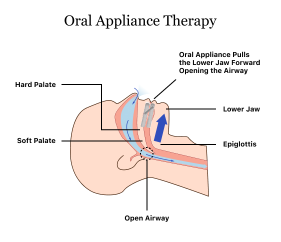 Oral Appliance Therapy Device